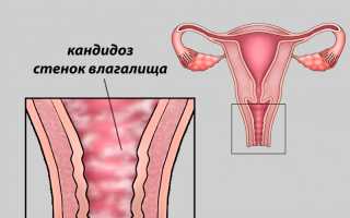 Вагинальный кандидоз анализ мазка