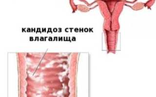 Можно ли забеременеть при молочнице у мужчин и женщин