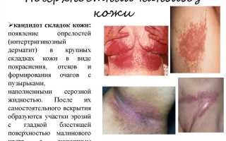 Чем лечить дрожжевой грибок молочница
