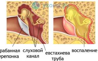 Микоз наружного слухового прохода что это такое